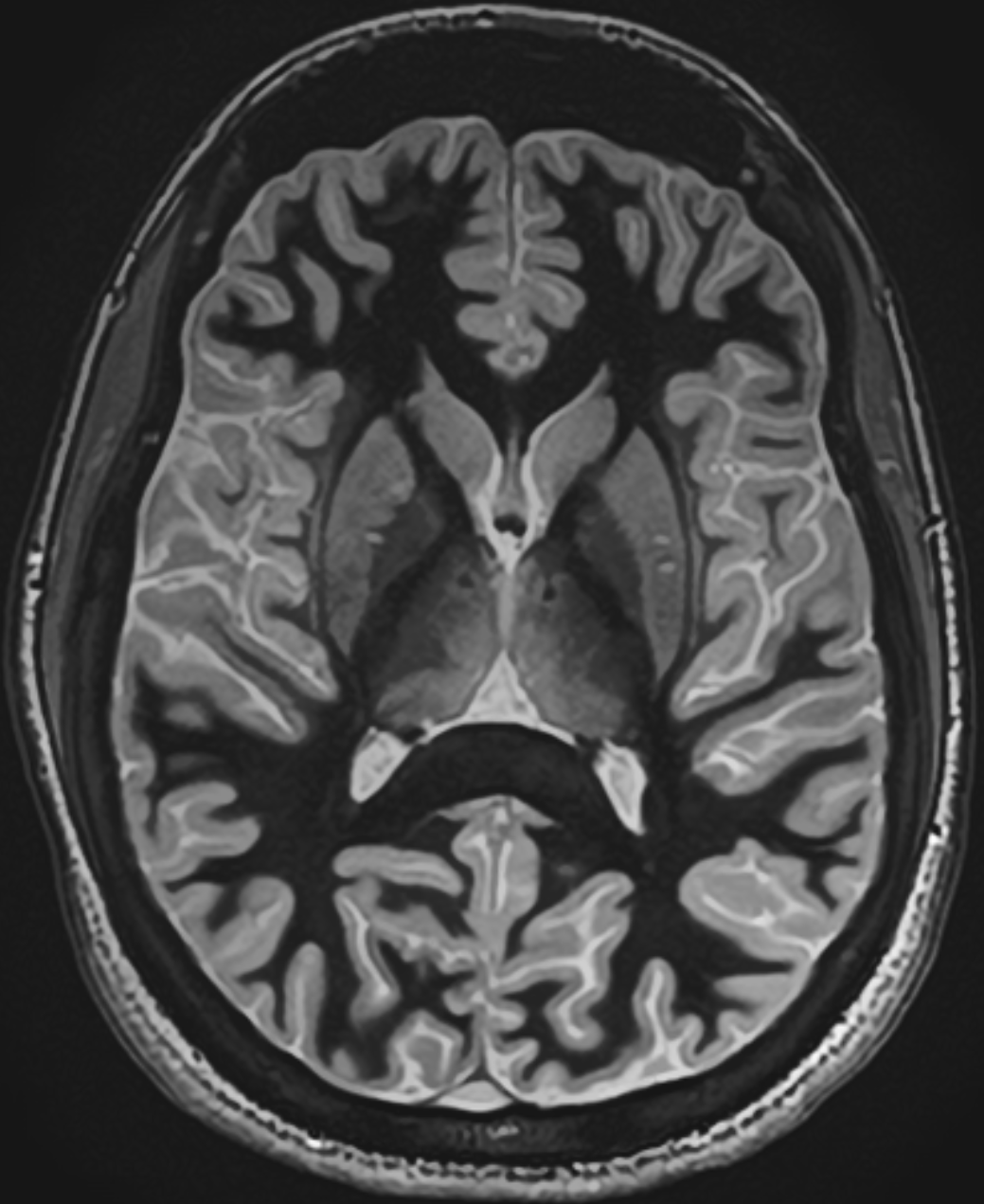 MRI brain full