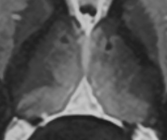 MRI thalamus zoom